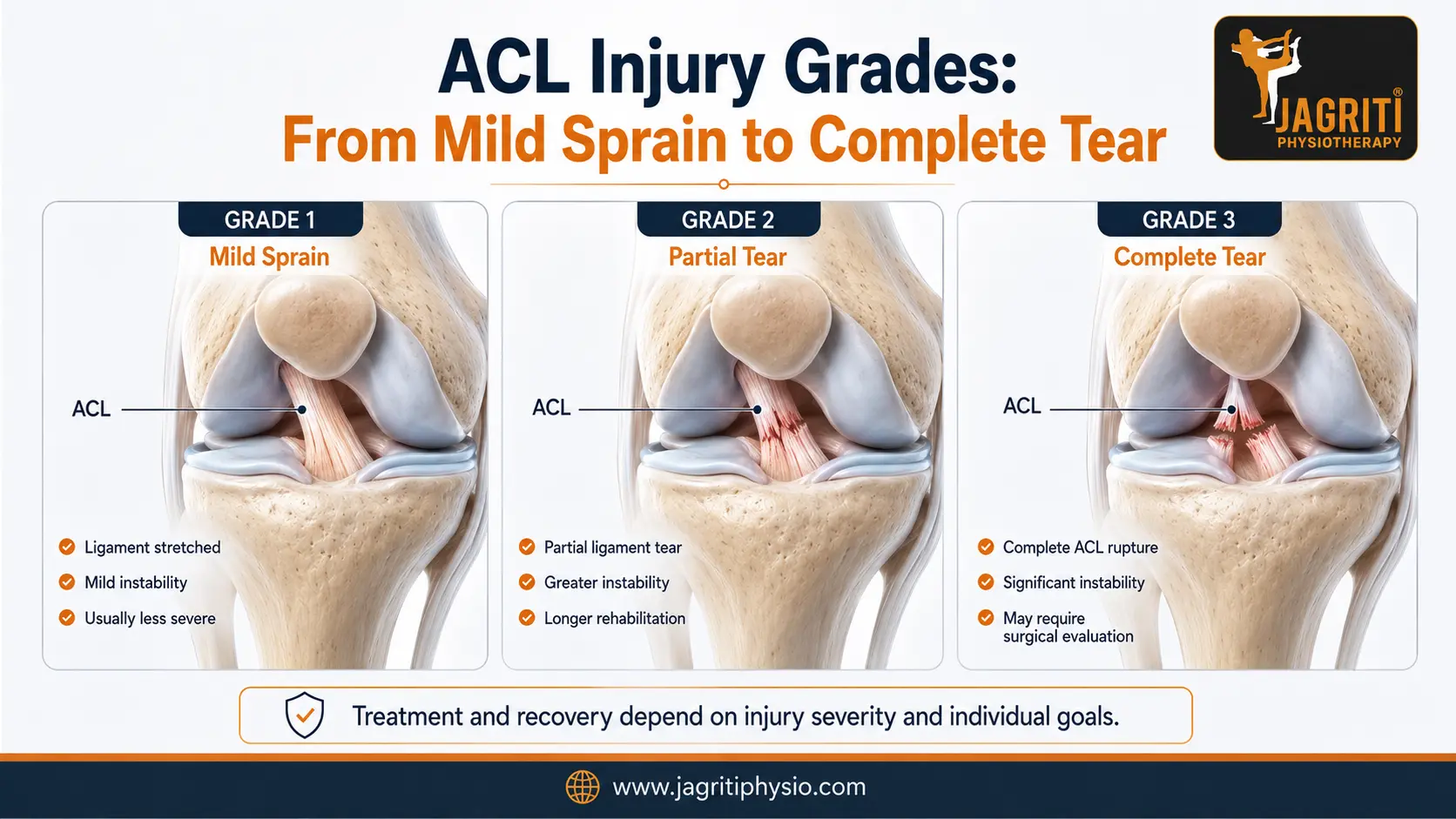 ACL Sprain Grades