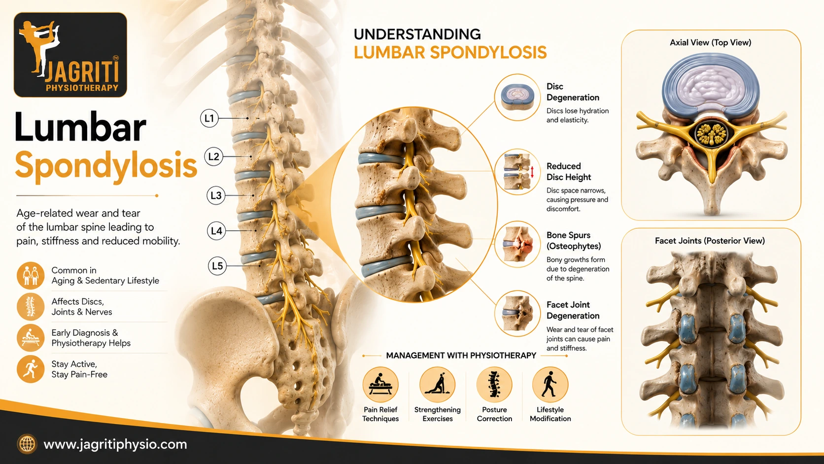 Lumbar Spondylosis